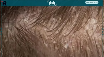 الرطوبة الزائدة.. أسباب قشرة الرأس وكيفية علاجها بفعالية